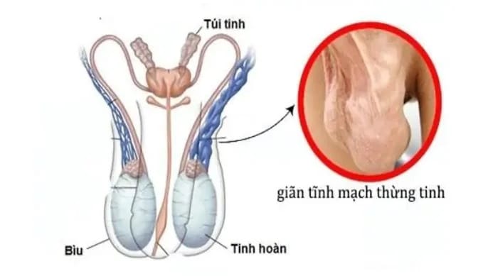 Giãn tĩnh mạch thừng tinh