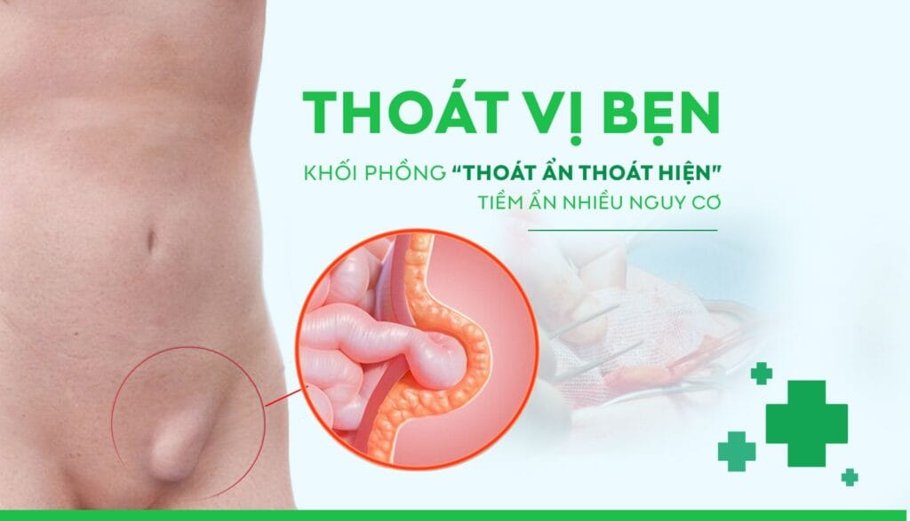Thoát vị bẹn