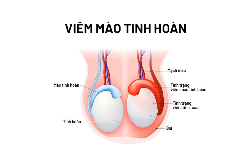 Viêm mào tinh hoàn