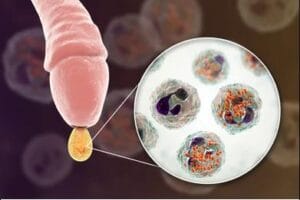 Bệnh lậu ở nam giới là gì? Biểu hiện, các giai đoạn & cách trị