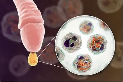 Bệnh lậu ở nam giới là gì? Biểu hiện, các giai đoạn & cách trị 1 Bệnh lậu ở nam là gì? Dấu hiệu, nguyên nhân & cách chữa