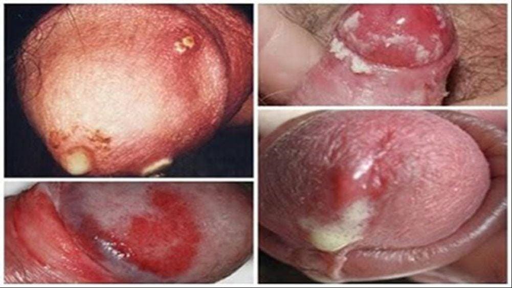 Bệnh lậu ở nam giới là gì? Biểu hiện, các giai đoạn & cách trị 3 Bệnh lậu tại bộ phận sinh dục nam