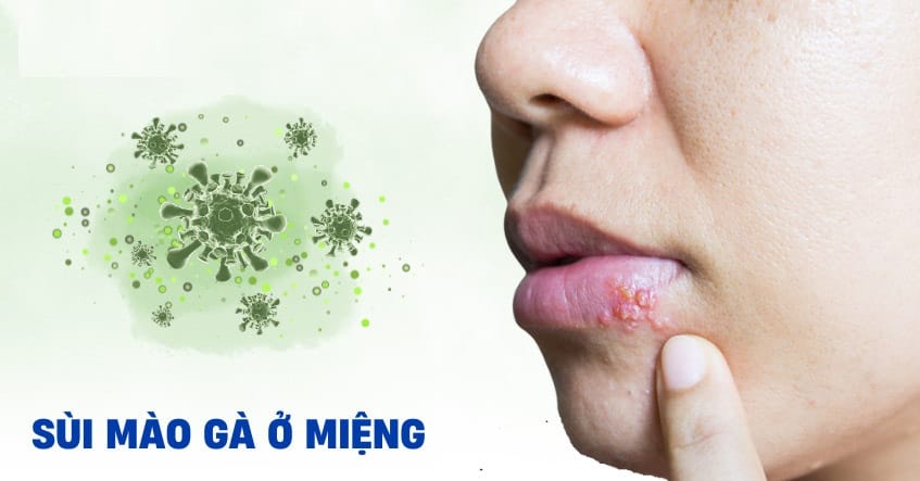 Triệu chứng sùi mào gà ở miệng và cách điều trị 1 Bệnh sùi mào gà ở miệng