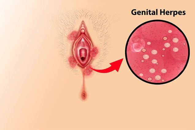 5 Dấu hiệu sùi mào gà ở nữ giai đoạn đầu 1 Bệnh sùi mào gà ở nữ