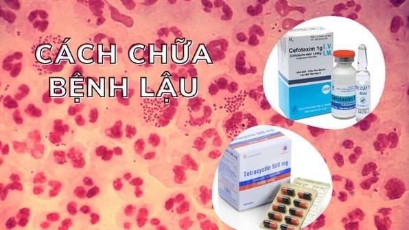 Cách Chữa Bệnh Lậu Ở Nam Giới: Hiệu Quả, Chi Tiết Và Dễ Áp Dụng 1 5 Cách chữa bệnh lậu ở nam giới "hiệu quả nhất" 2025