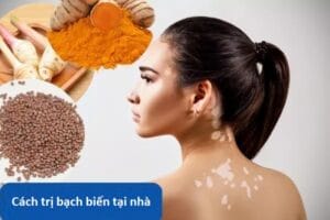 5 Cách trị bạch biến tại nhà “đơn giản” dễ thực hiện