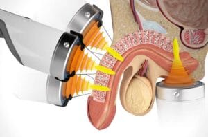 Điều trị rối loạn cương dương ở Phú Thọ | Phòng Khám Đa Khoa Tân Thành