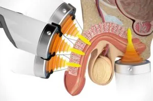 Điều trị rối loạn cương dương ở Phú Thọ | Phòng Khám Đa Khoa Tân Thành