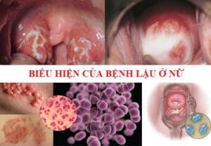 Bệnh lậu ở nữ giới: 5 biểu hiện chị em cần biết sớm giai đoạn đầu
