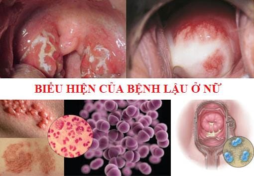 Bệnh lậu ở nữ giới: 5 biểu hiện chị em cần biết sớm giai đoạn đầu