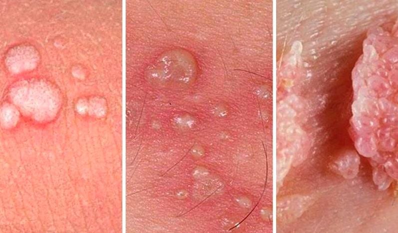5 Dấu hiệu sùi mào gà ở nữ giai đoạn đầu 3 Dấu hiệu sùi mào gà ở nữ