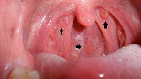 Dấu Hiệu Bệnh Lậu Ở Nam Giới: 5 Triệu Chứng Cảnh Báo Bạn Cần Biết 6 Nam giới đau họng và viêm hầu họng