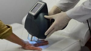 Điều trị bạch biến bằng laser: Hiệu quả và thời gian điều trị