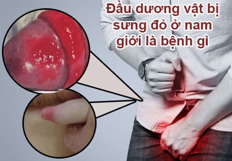 Dấu Hiệu Bệnh Lậu Ở Nam Giới: 5 Triệu Chứng Cảnh Báo Bạn Cần Biết 4 Dương vật sưng đỏ, nổi mẩn