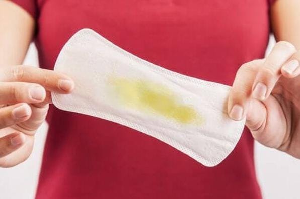 Bệnh lậu ở nữ giới: 5 biểu hiện chị em cần biết sớm giai đoạn đầu 3 Khí hư màu vàng