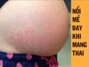 Nổi mề đay khi mang thai: Nguyên nhân & cách xử lý
