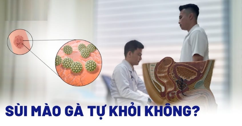 Sùi mào gà nhẹ có tự hết không? 3 lưu ý nam giới cần biết 2 sui mao ga nhe co tu het khong