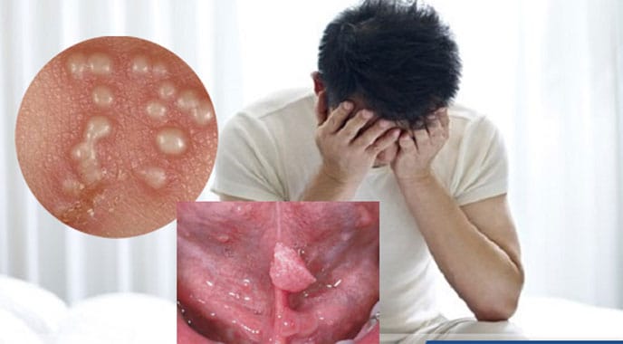 Sùi mào gà nhẹ có tự hết không? 3 lưu ý nam giới cần biết 1 Bệnh sùi mào gà nhẹ ở nam