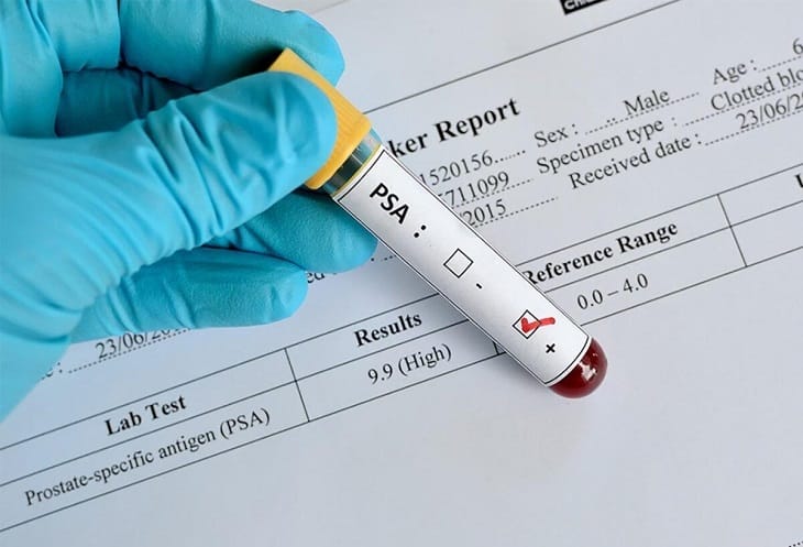 Địa Chỉ Khám Nam Khoa Ở Việt Trì Uy Tín | Phòng Khám Đa Khoa Tân Thành 3 Xét nghiệp viêm tuyến tiền liệt PSA