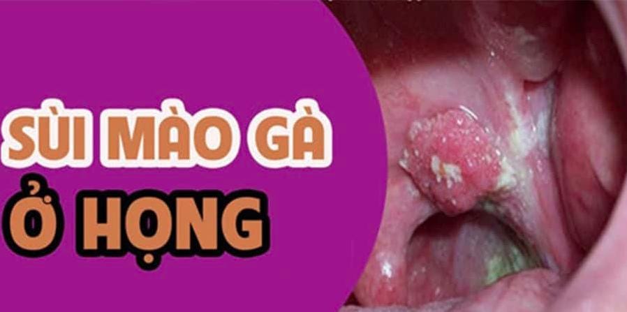 Sùi Mào Gà Ở Họng: Hiểu Rõ Nguyên Nhân, Triệu Chứng & Nguy Hiểm